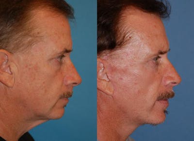 Male Facelift Before & After Gallery - Patient 122406276 - Image 1