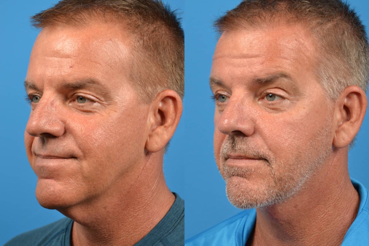Male Neck Lift Before & After Gallery - Patient 122406281 - Image 2