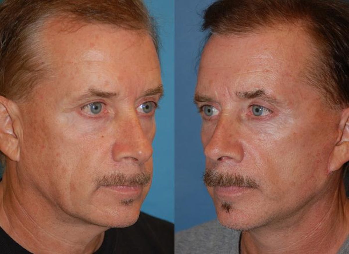 Male Facelift Before & After Gallery - Patient 122406276 - Image 2