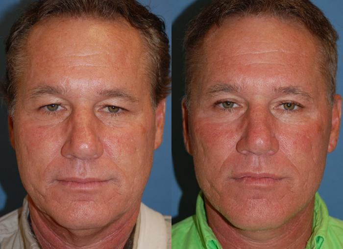 Male Facelift Before & After Gallery - Patient 122406278 - Image 1