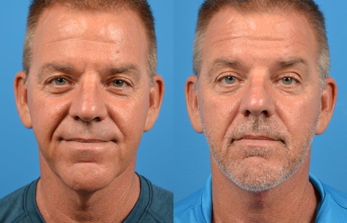 Male Neck Lift Before & After Gallery - Patient 122406281 - Image 3