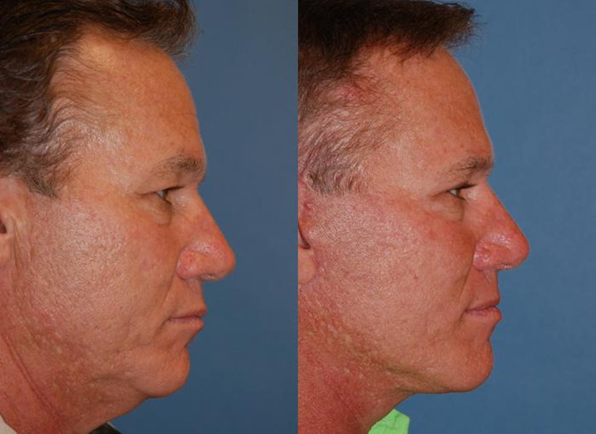 Male Facelift Before & After Gallery - Patient 122406278 - Image 2