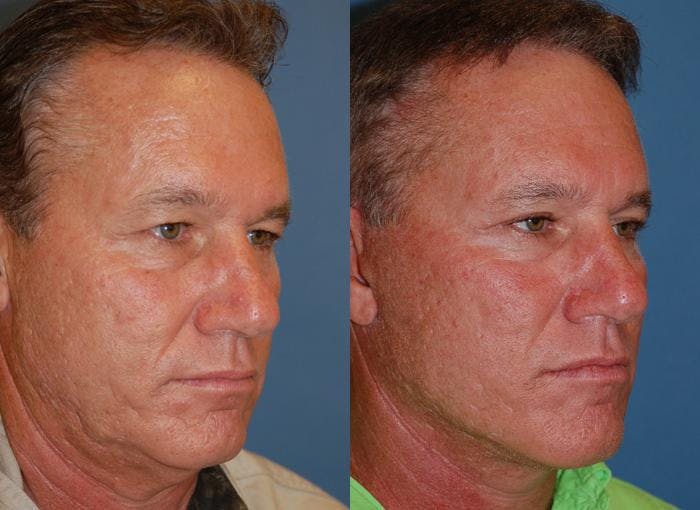 Male Facelift Before & After Gallery - Patient 122406278 - Image 3