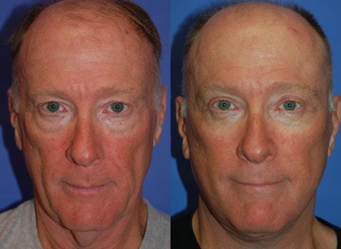 Male Facelift Before & After Gallery - Patient 122406279 - Image 1