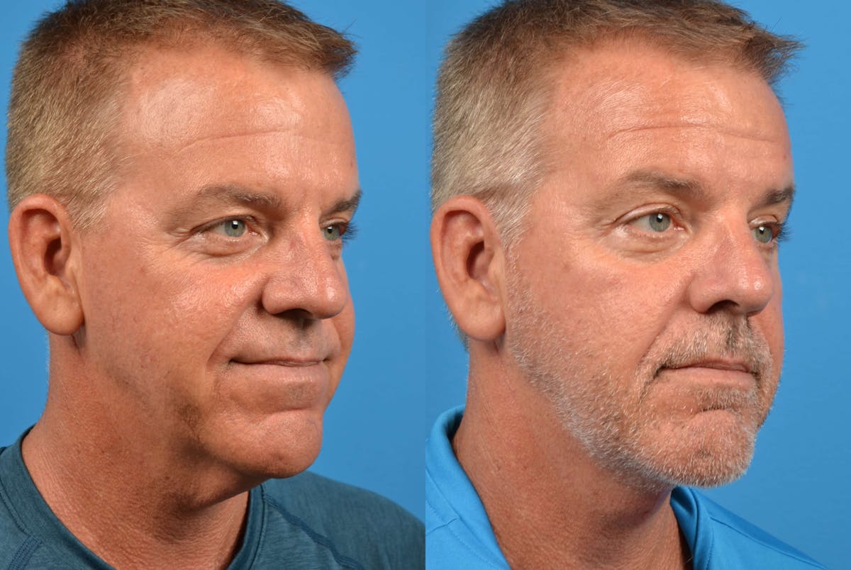 Male Neck Lift Before & After Gallery - Patient 122406281 - Image 4