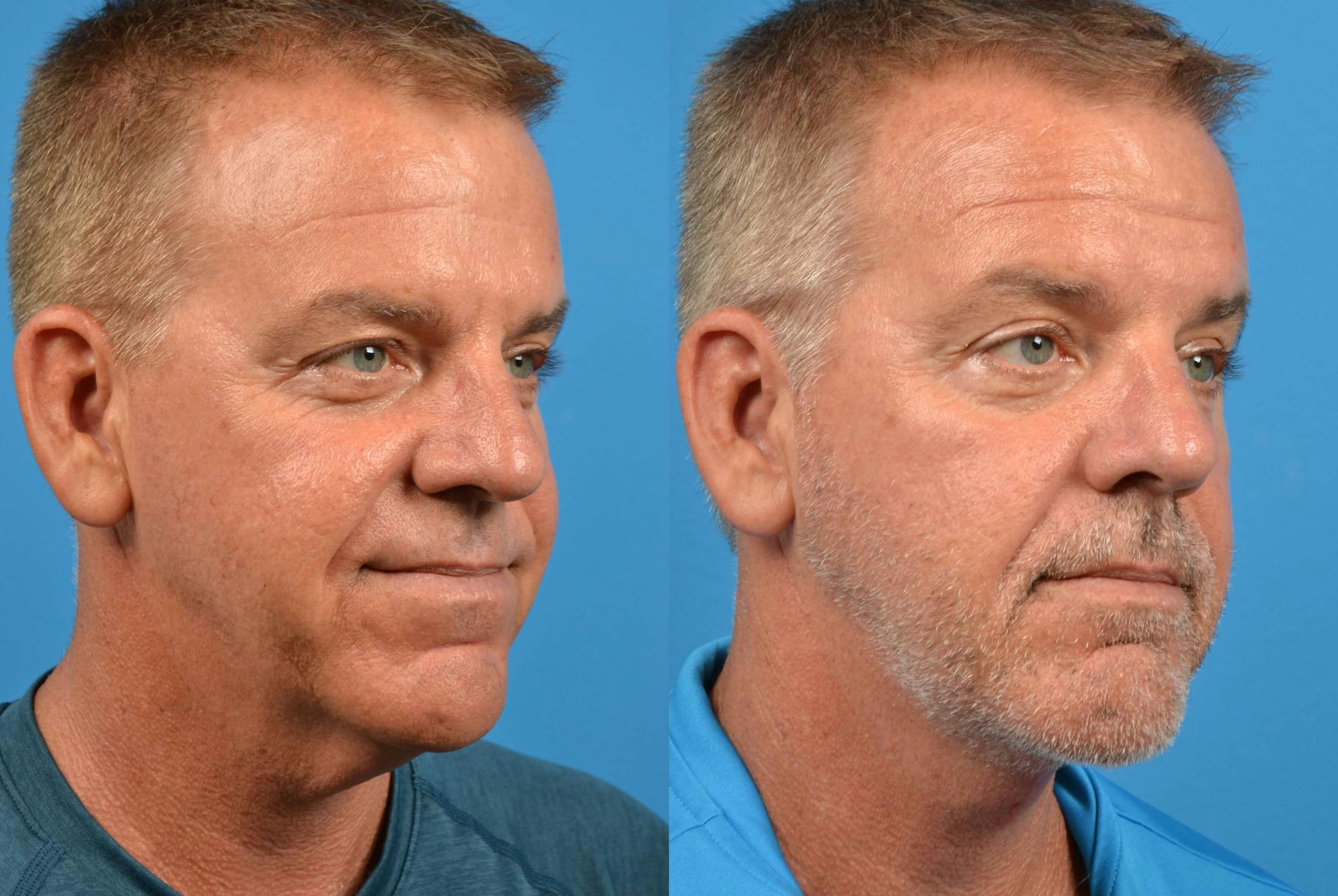Male Neck Lift Before & After Gallery - Patient 122406281 - Image 4