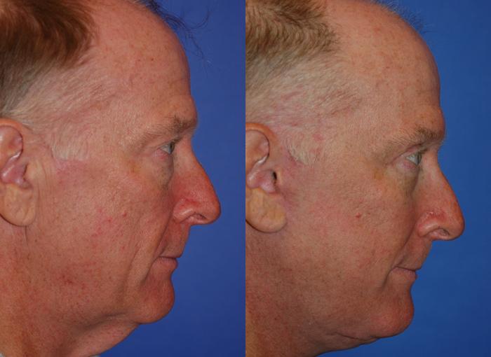 Male Facelift Before & After Gallery - Patient 122406279 - Image 2