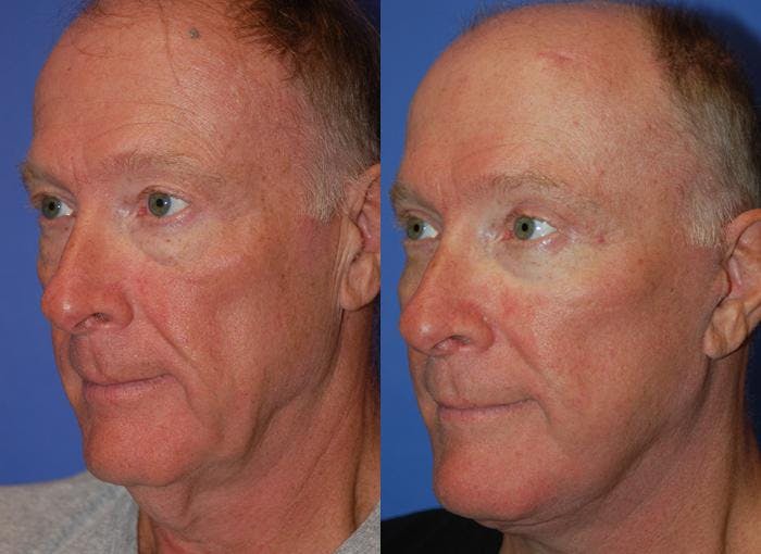 Male Facelift Before & After Gallery - Patient 122406279 - Image 3