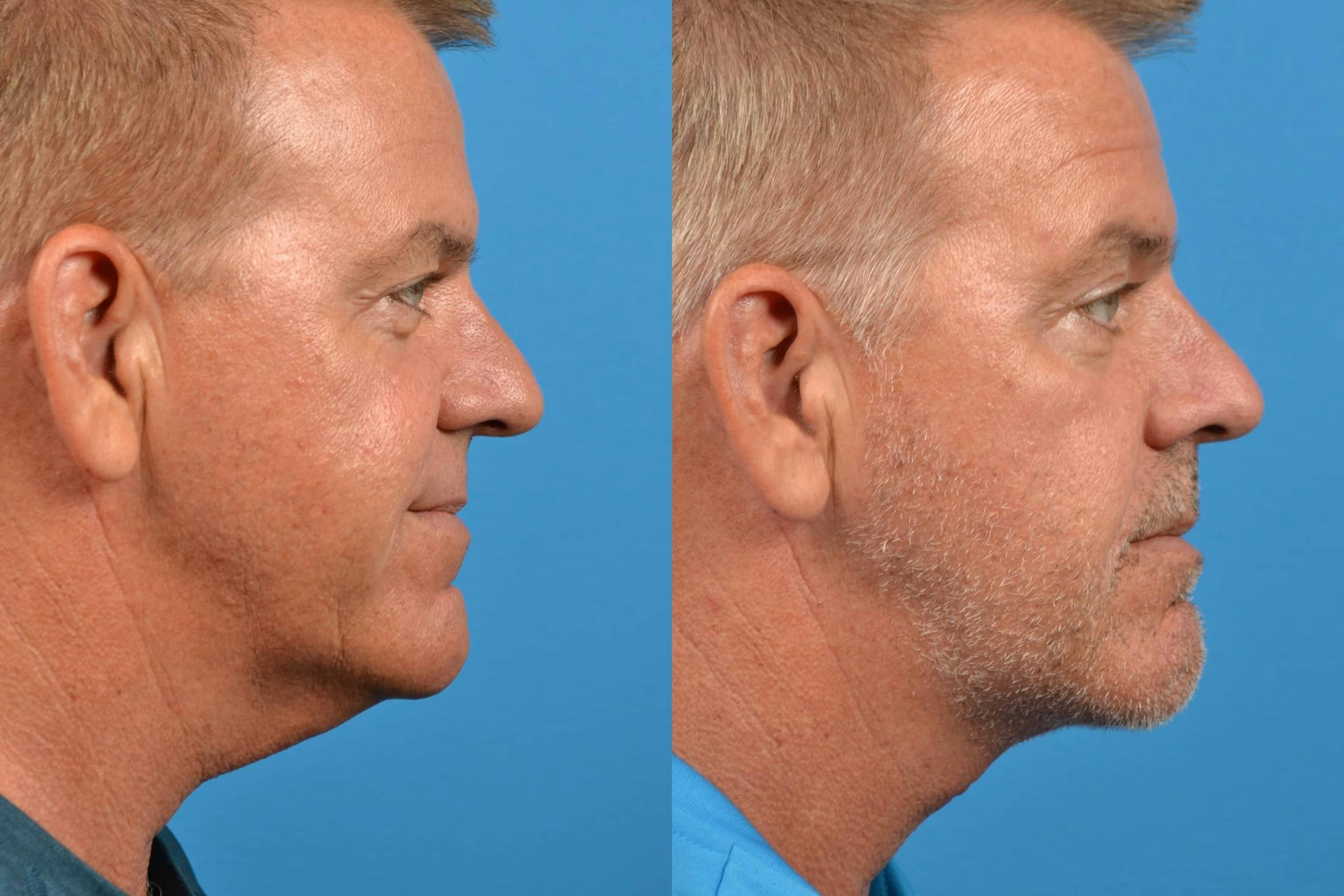 Male Neck Lift Before & After Gallery - Patient 122406281 - Image 5