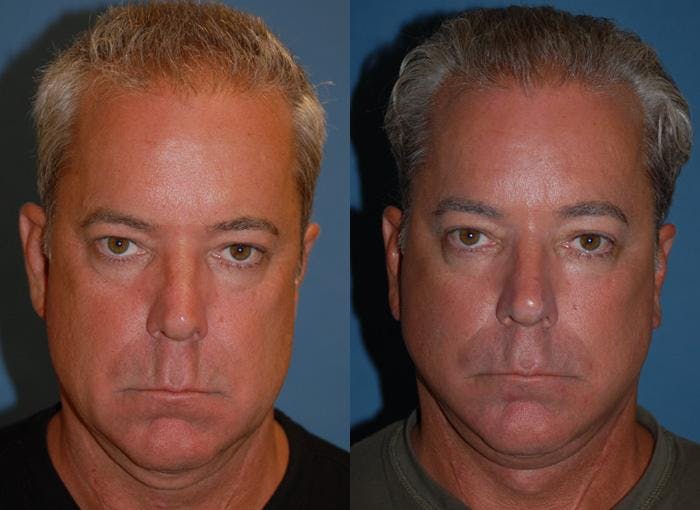 Male Facelift Before & After Gallery - Patient 122406282 - Image 1