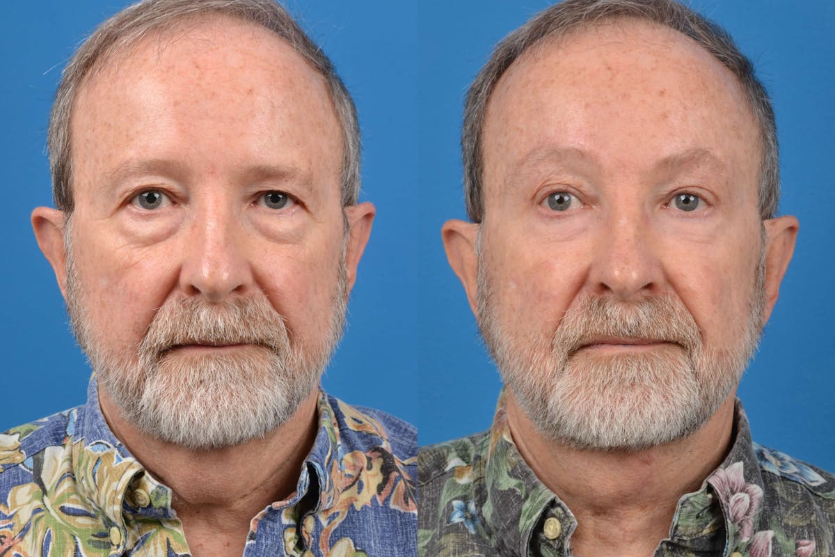 Male Neck Lift Before & After Gallery - Patient 122406284 - Image 1