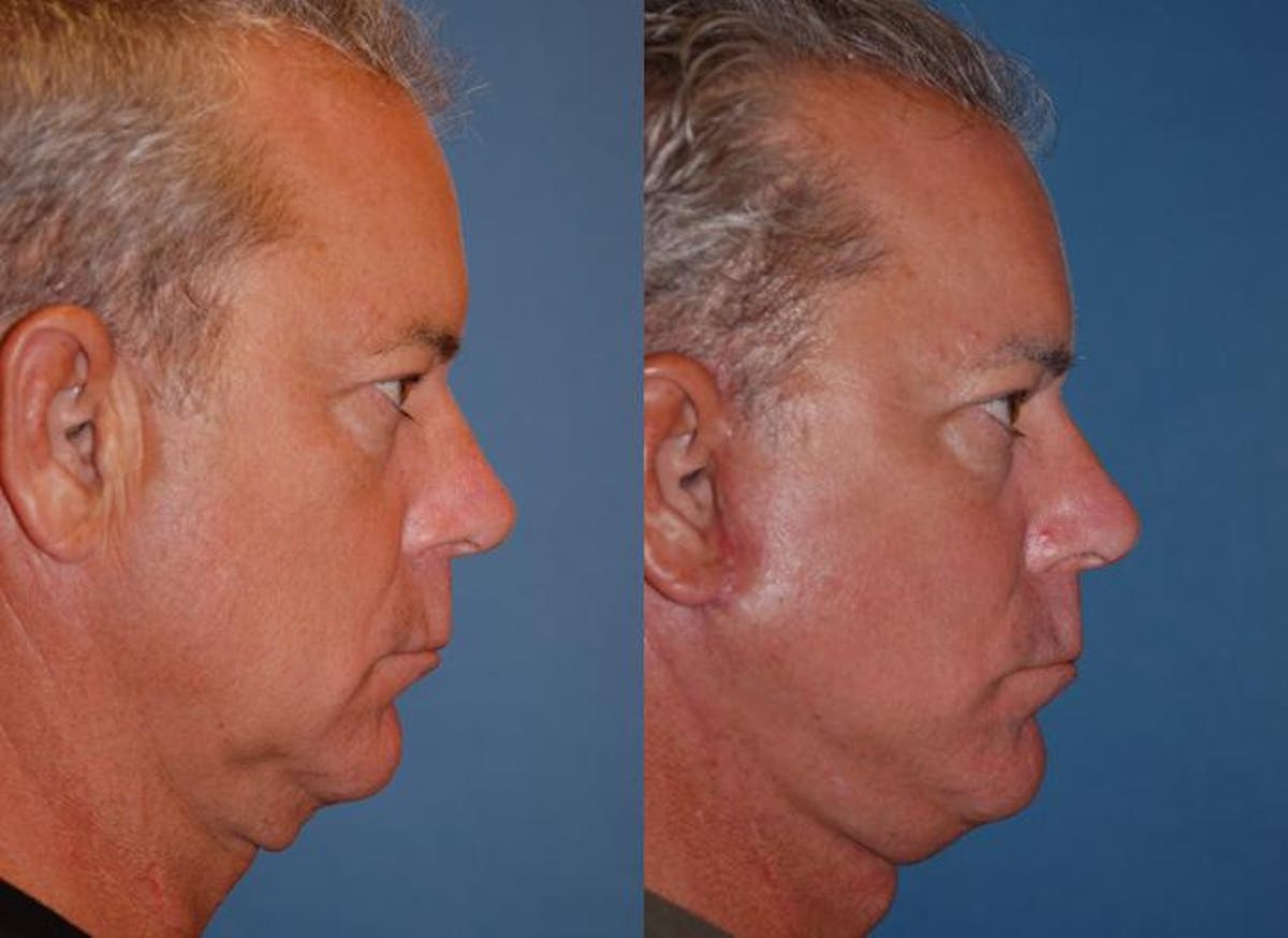 Male Facelift Before & After Gallery - Patient 122406282 - Image 2
