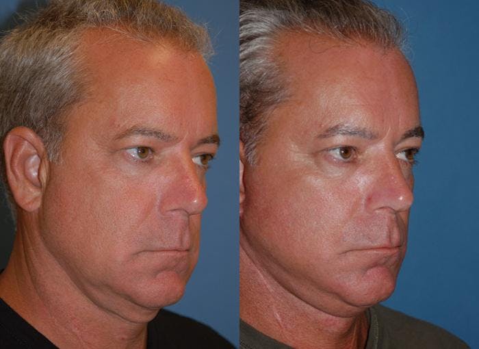 Male Facelift Before & After Gallery - Patient 122406282 - Image 3