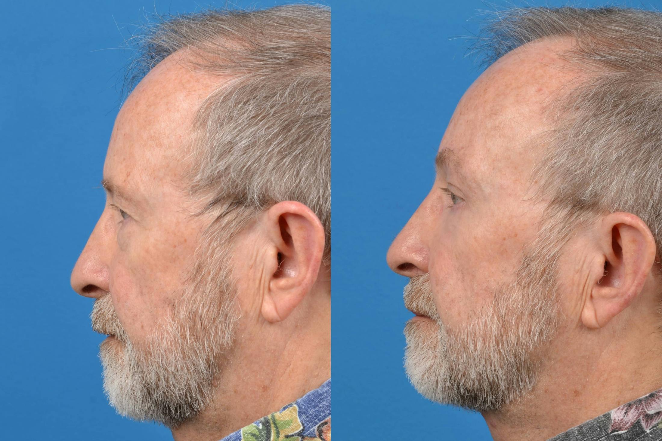 Male Neck Lift Before & After Gallery - Patient 122406284 - Image 2