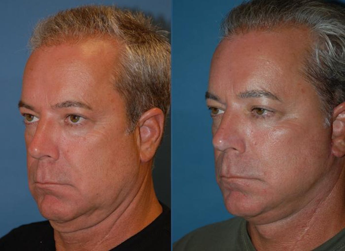 Male Facelift Before & After Gallery - Patient 122406282 - Image 4