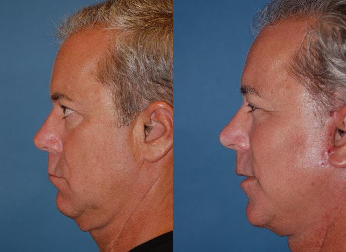 Male Facelift Before & After Gallery - Patient 122406282 - Image 5