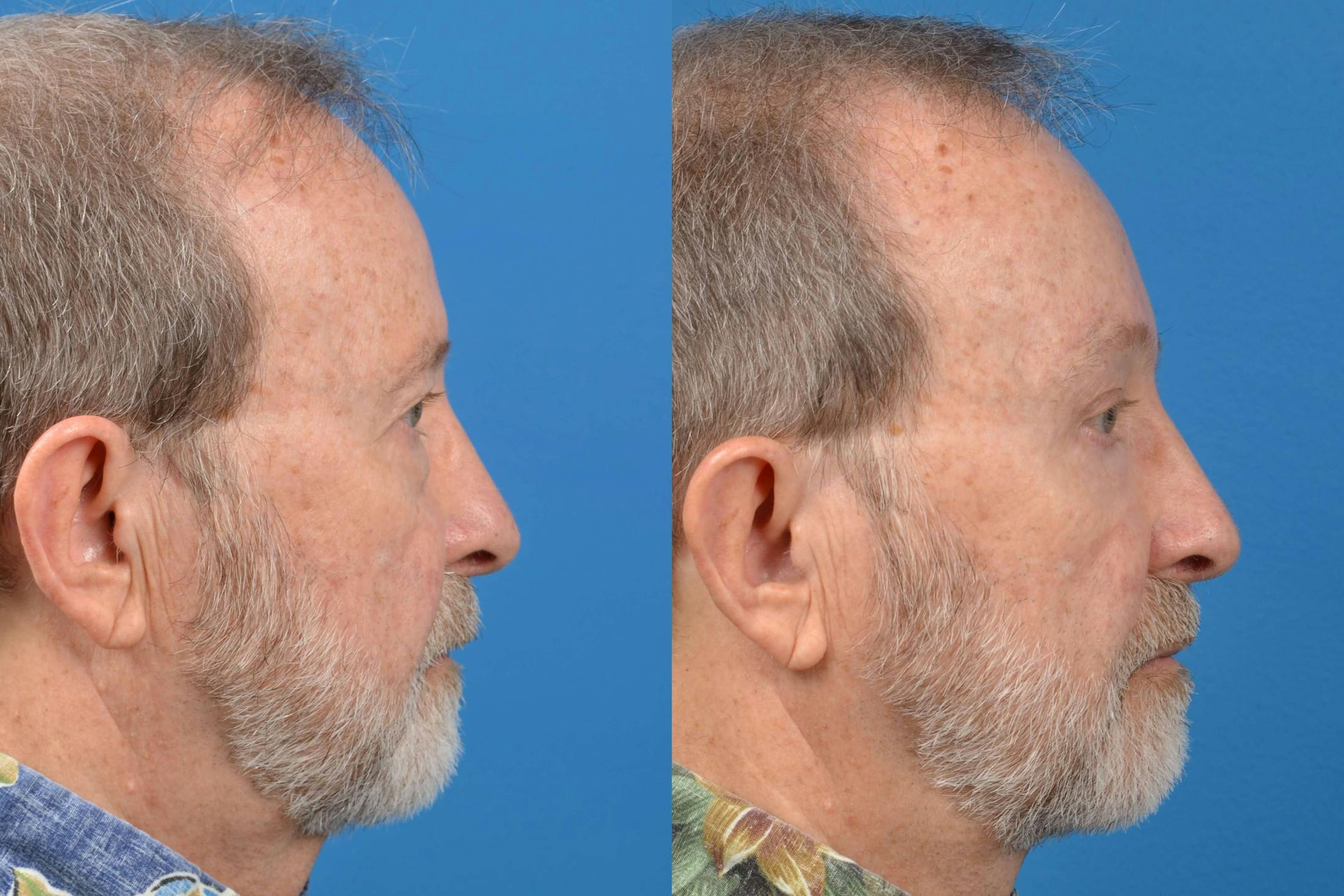 Male Neck Lift Before & After Gallery - Patient 122406284 - Image 5