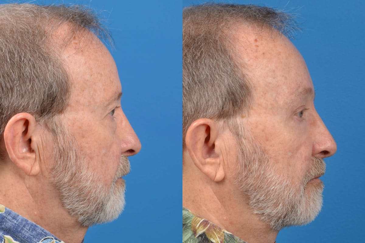 Male Neck Lift Before & After Gallery - Patient 122406284 - Image 5