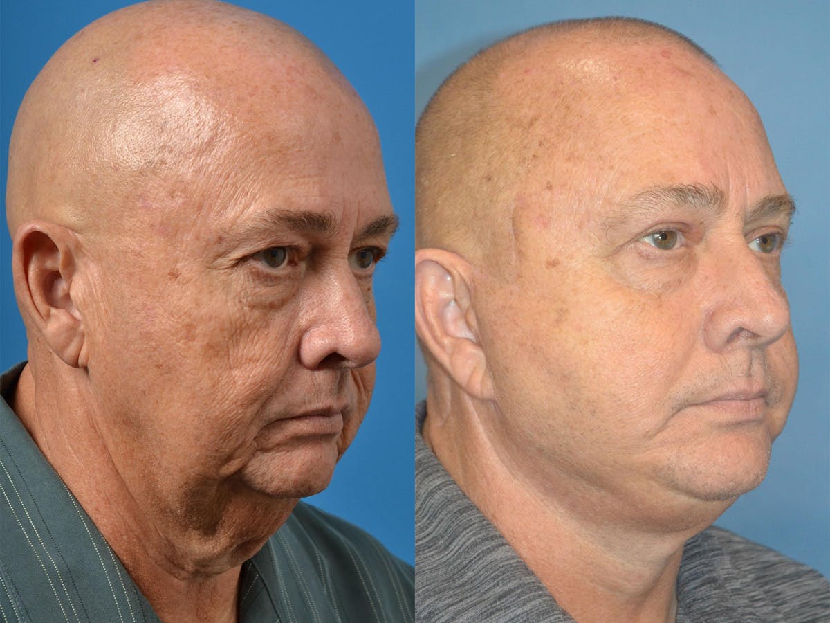 Male Facelift Before & After Gallery - Patient 122406286 - Image 3