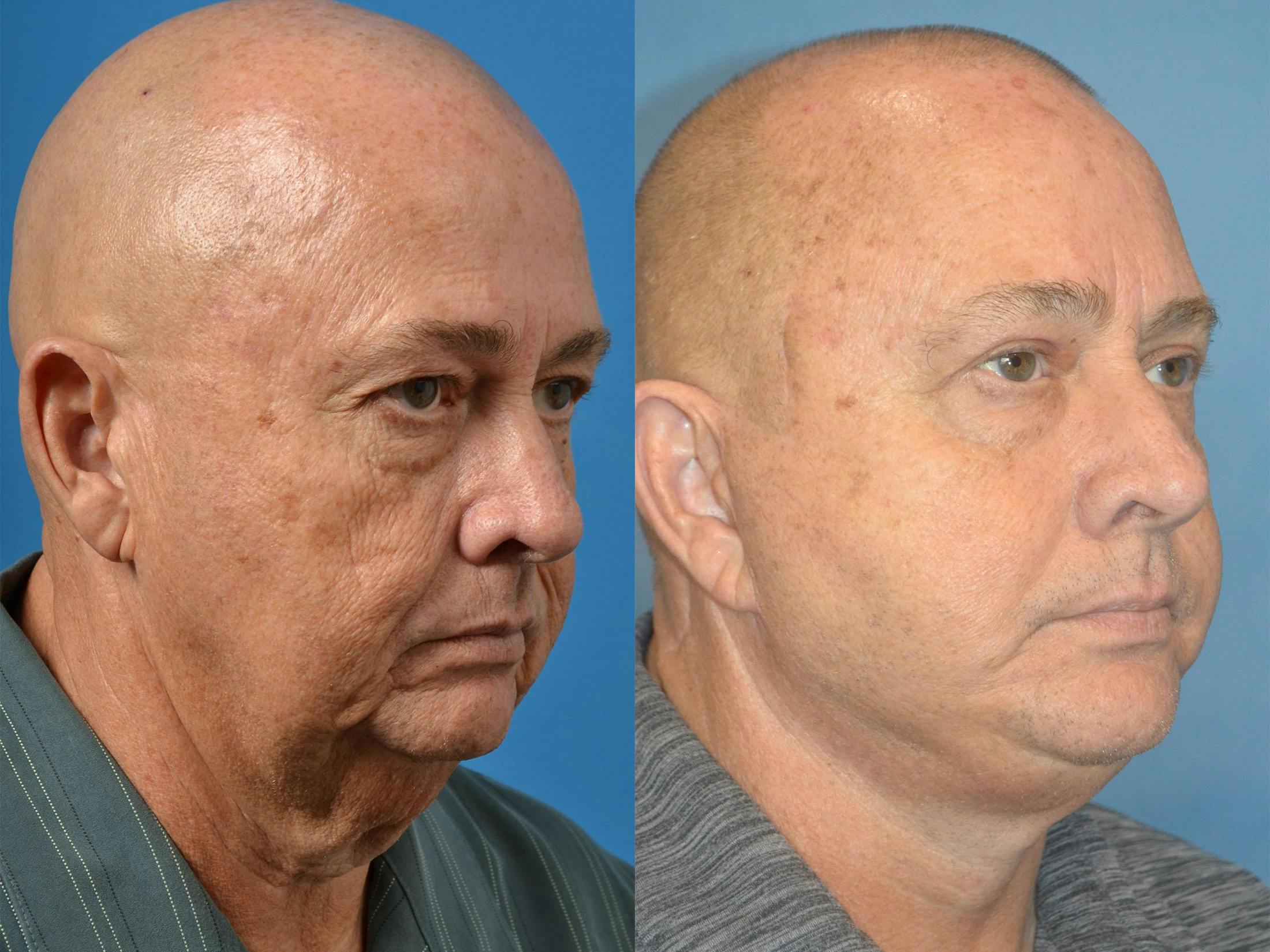 Male Facelift Before & After Gallery - Patient 122406286 - Image 3