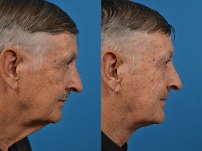 Male Neck Lift Before & After Gallery - Patient 122406287 - Image 1