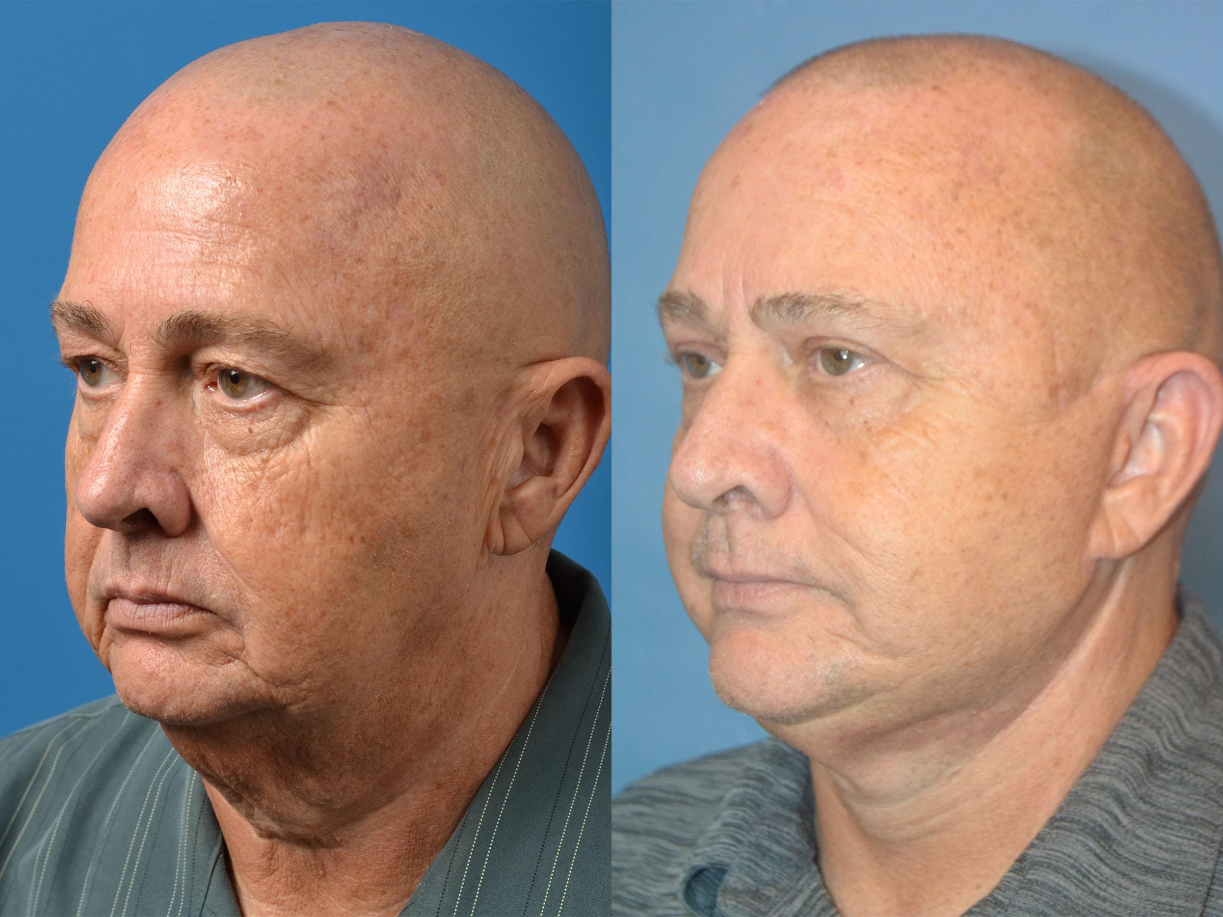 Male Facelift Before & After Gallery - Patient 122406286 - Image 4
