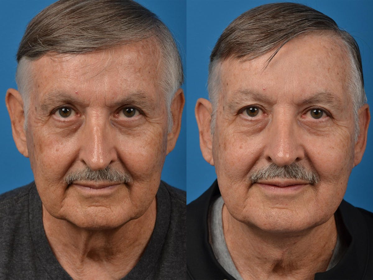 Male Neck Lift Before & After Gallery - Patient 122406287 - Image 2