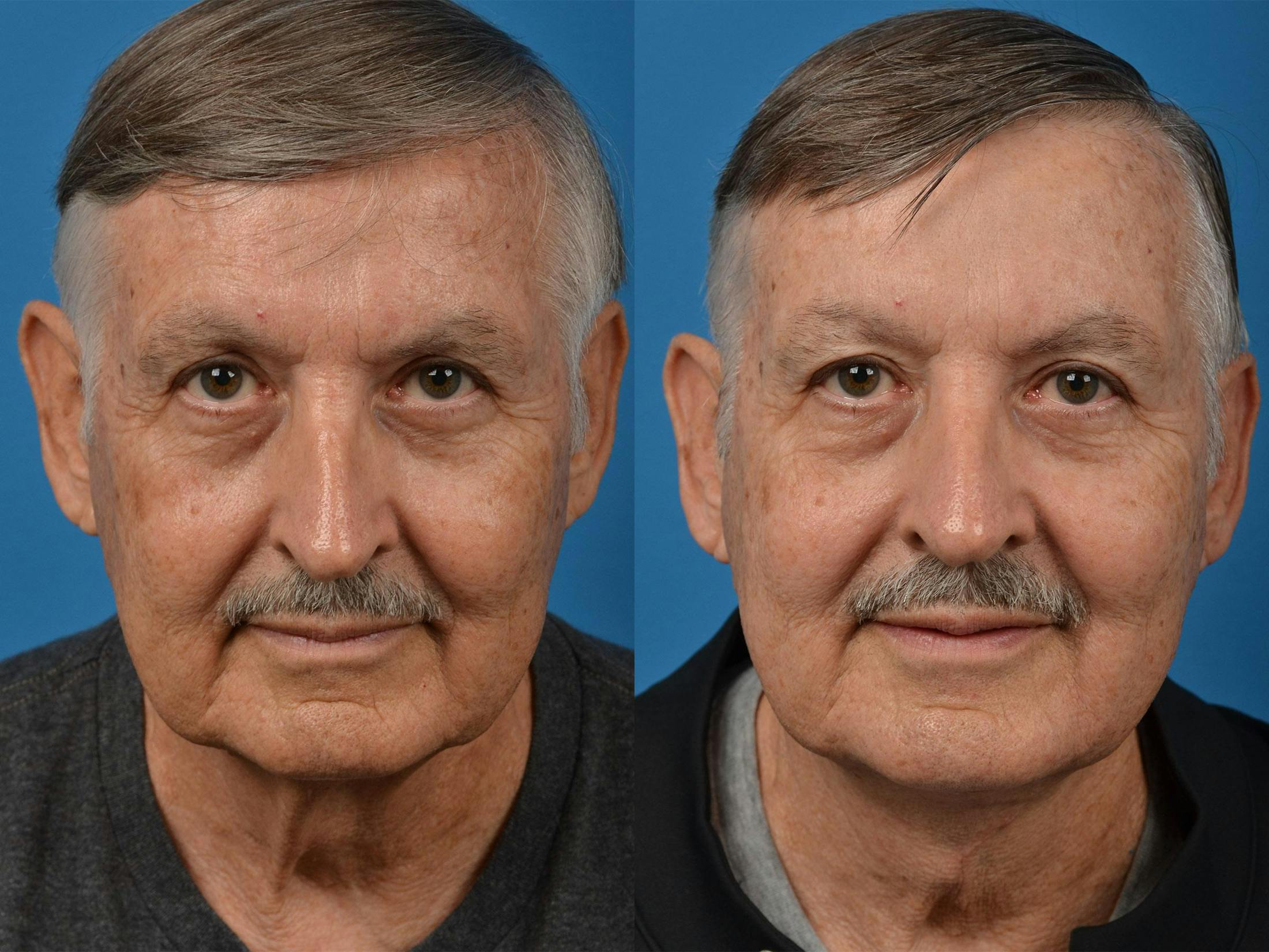 Male Neck Lift Before & After Gallery - Patient 122406287 - Image 2