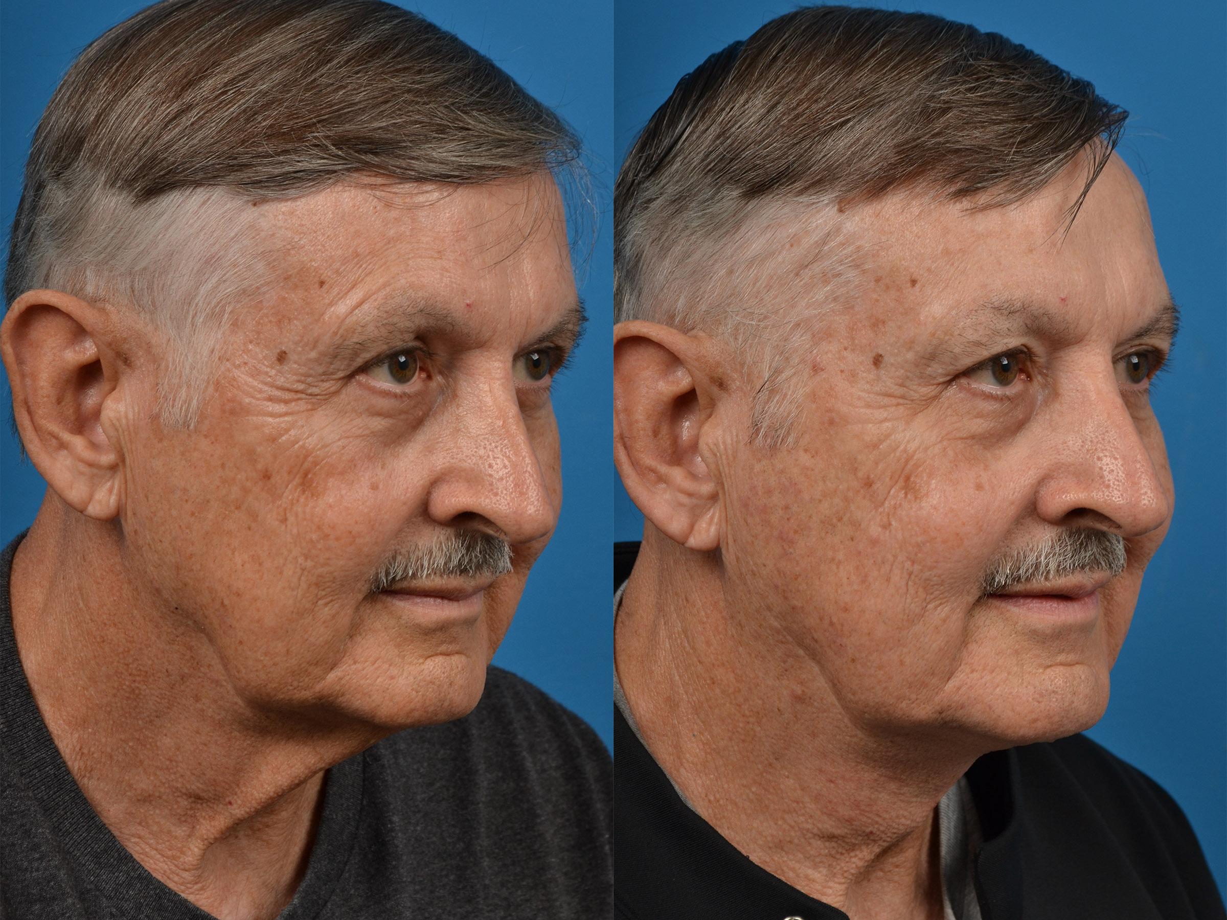Male Neck Lift Before & After Gallery - Patient 122406287 - Image 3