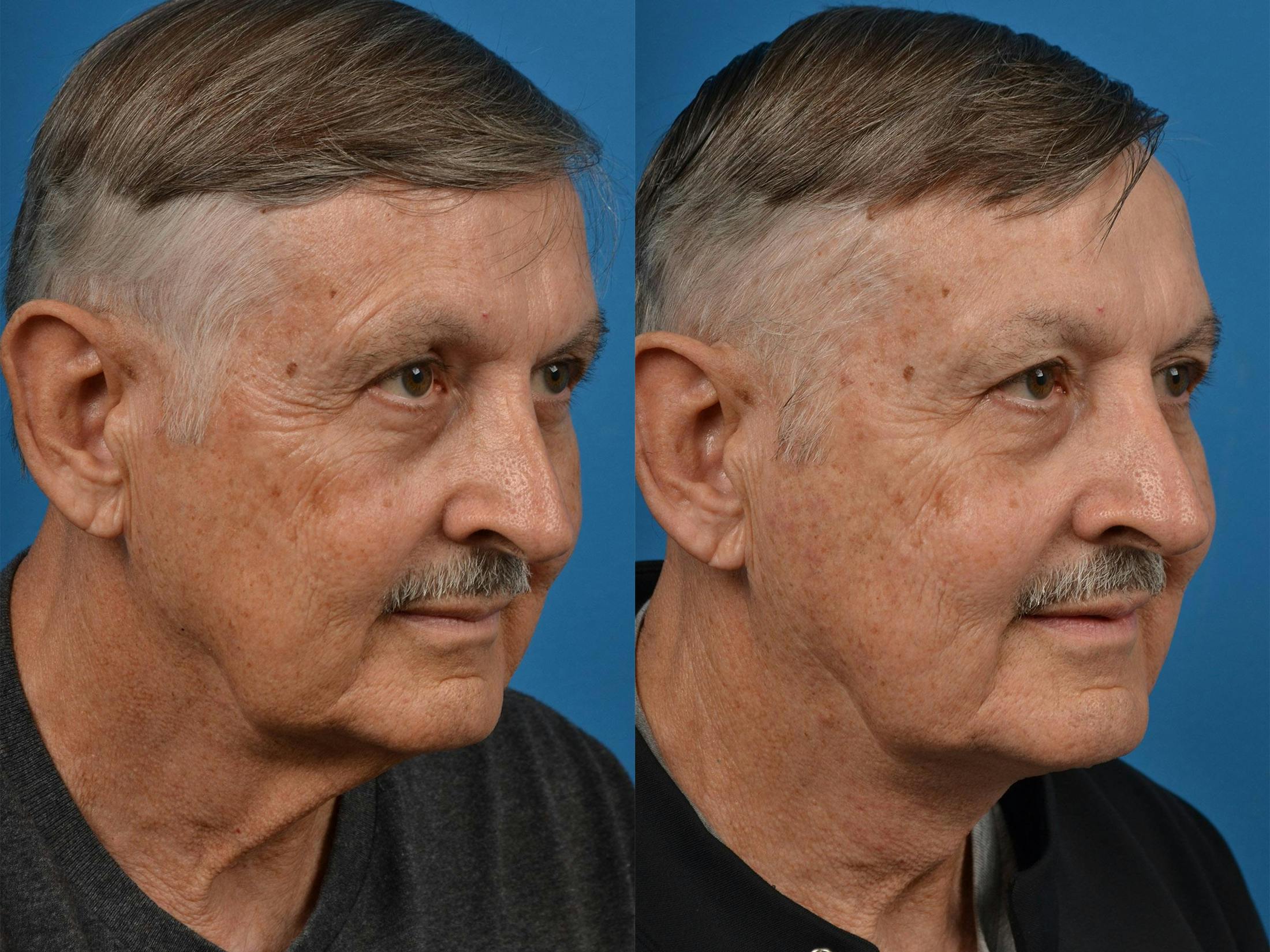 Male Neck Lift Before & After Gallery - Patient 122406287 - Image 3