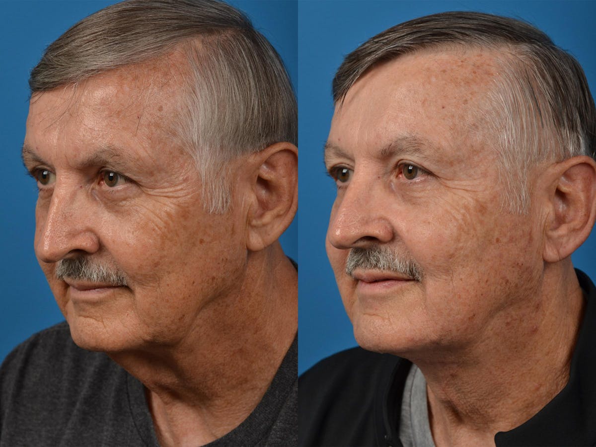 Male Neck Lift Before & After Gallery - Patient 122406287 - Image 4
