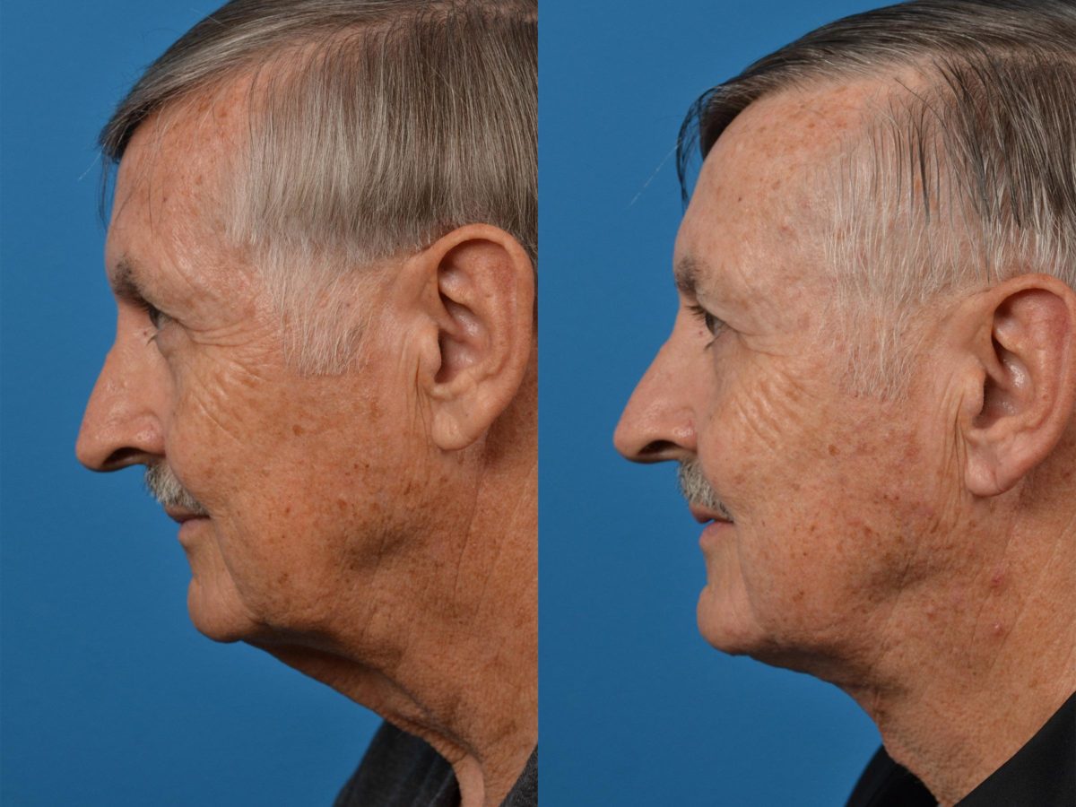 Male Neck Lift Before & After Gallery - Patient 122406287 - Image 5