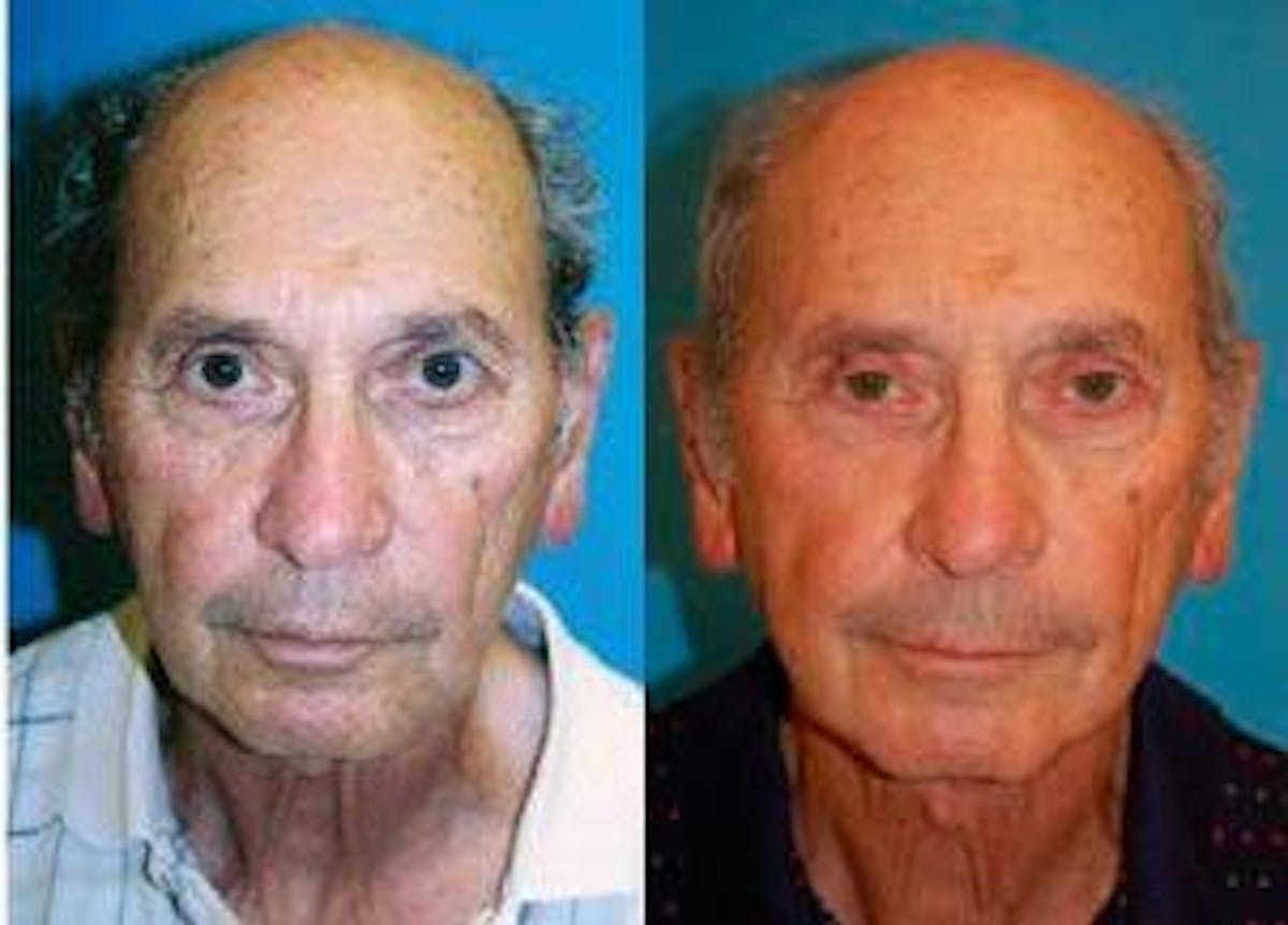 Male Neck Lift Before & After Gallery - Patient 122406289 - Image 1