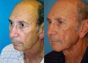 Male Neck Lift Before & After Gallery - Patient 122406289 - Image 2