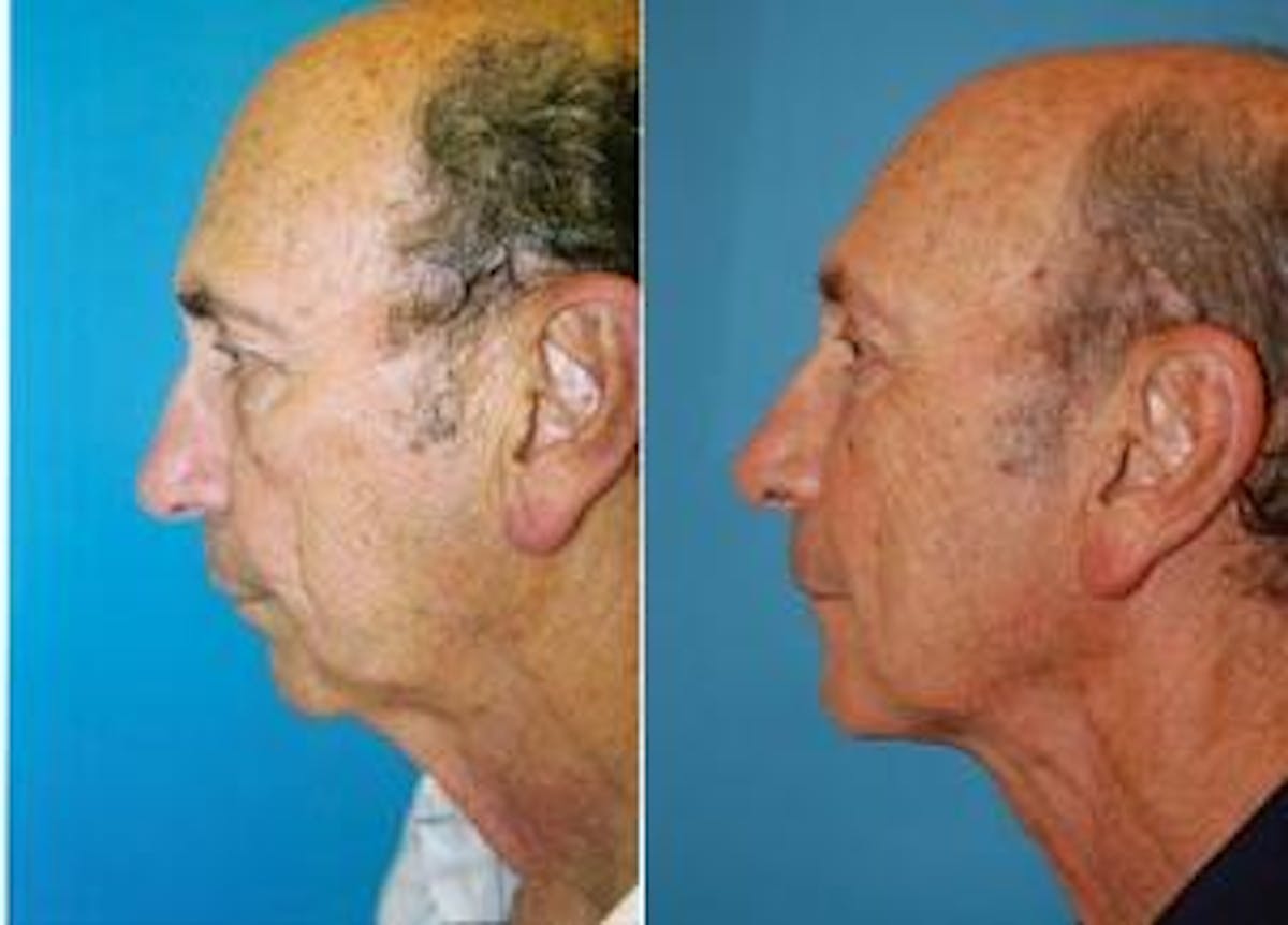 Male Neck Lift Before & After Gallery - Patient 122406289 - Image 3