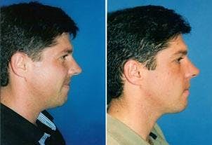 Male Neck Lift Before & After Gallery - Patient 122406291 - Image 1