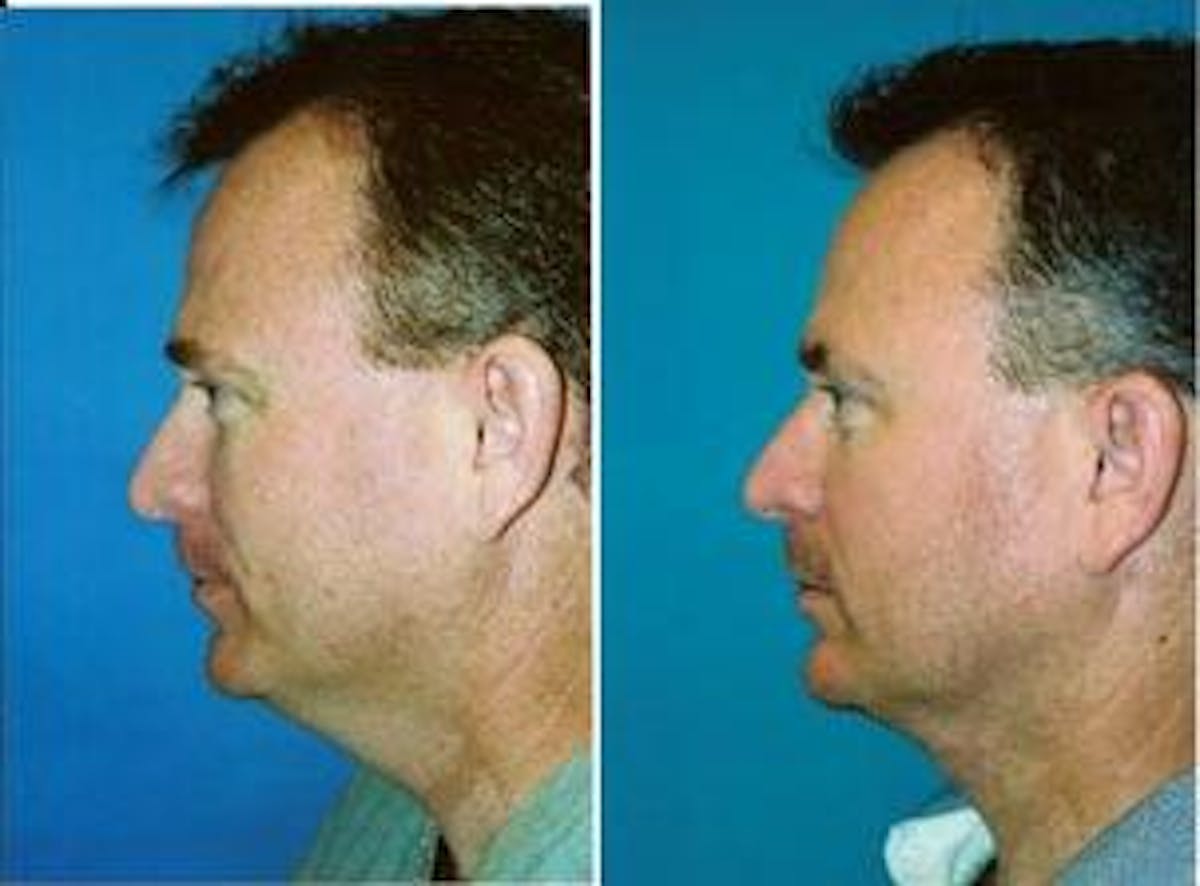 Male Neck Lift Before & After Gallery - Patient 122406292 - Image 1