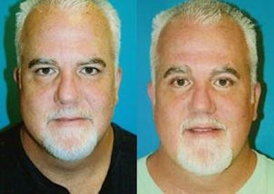 Male Neck Lift Before & After Gallery - Patient 122406294 - Image 1