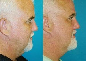 Male Neck Lift Before & After Gallery - Patient 122406294 - Image 2
