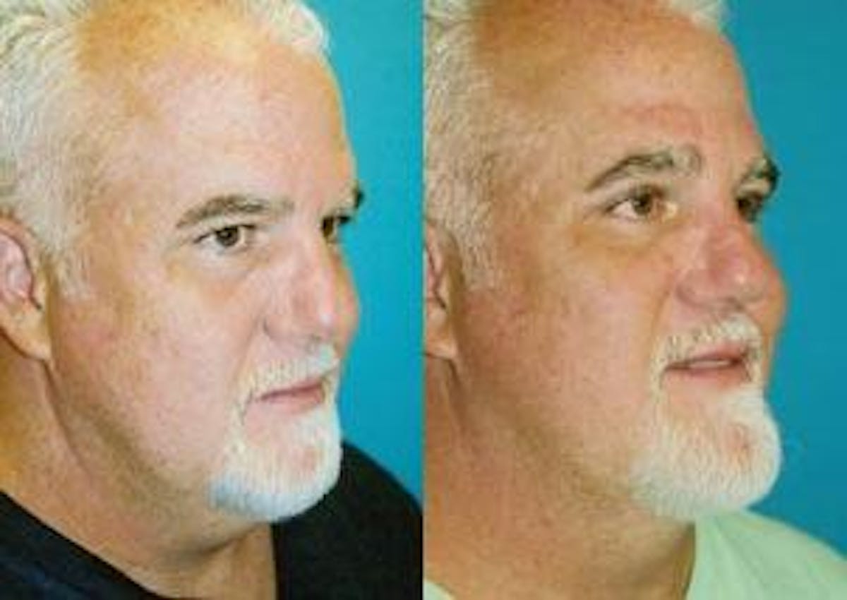 Male Neck Lift Before & After Gallery - Patient 122406294 - Image 3