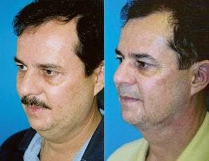 Male Neck Lift Before & After Gallery - Patient 122406295 - Image 2