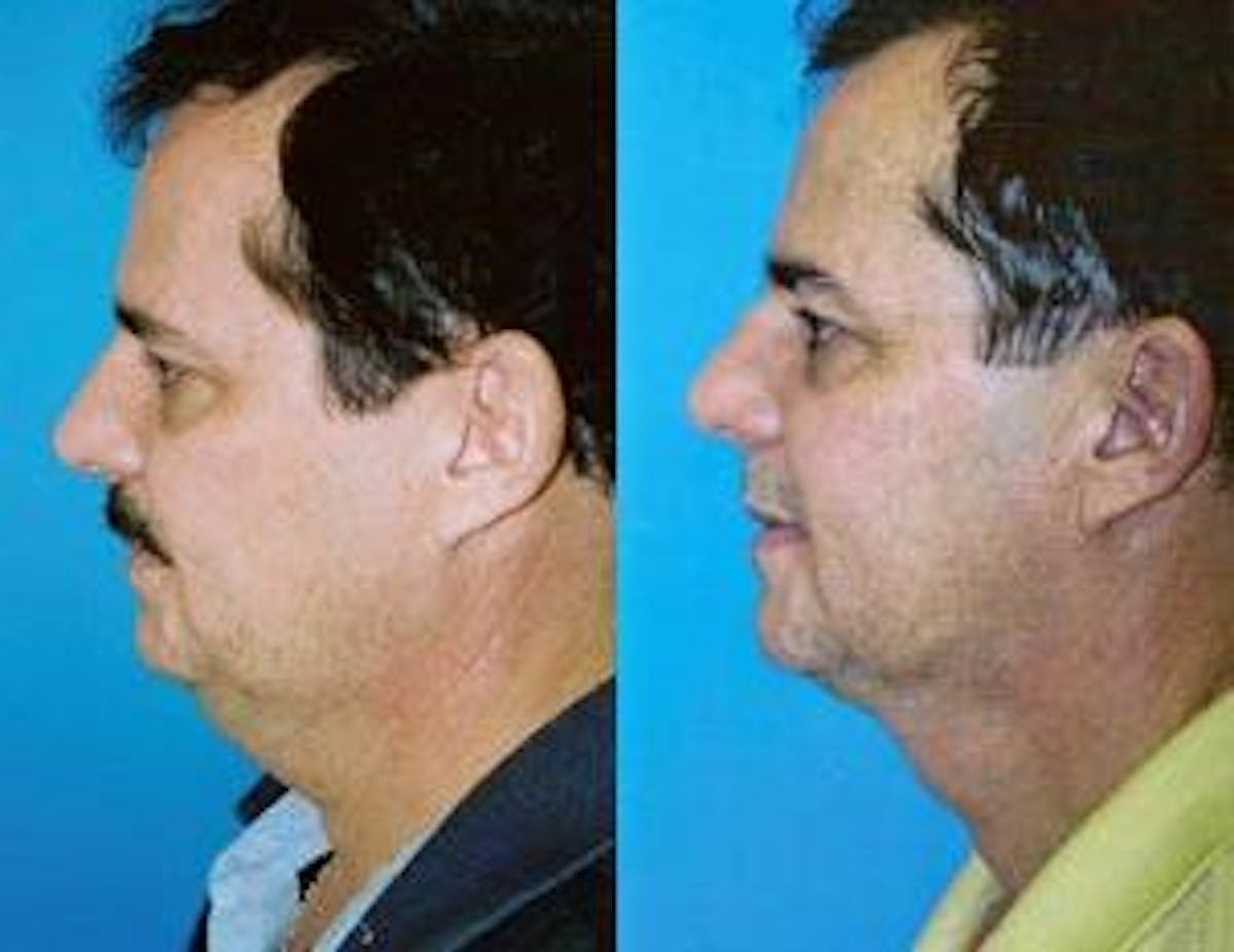 Male Neck Lift Before & After Gallery - Patient 122406295 - Image 3