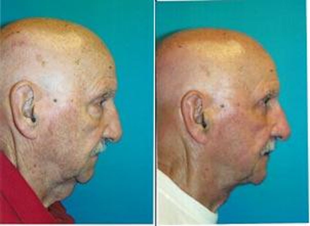 Male Neck Lift Before & After Gallery - Patient 122406298 - Image 2