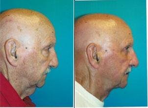 Male Neck Lift Gallery - Patient 122406298 - Image 2