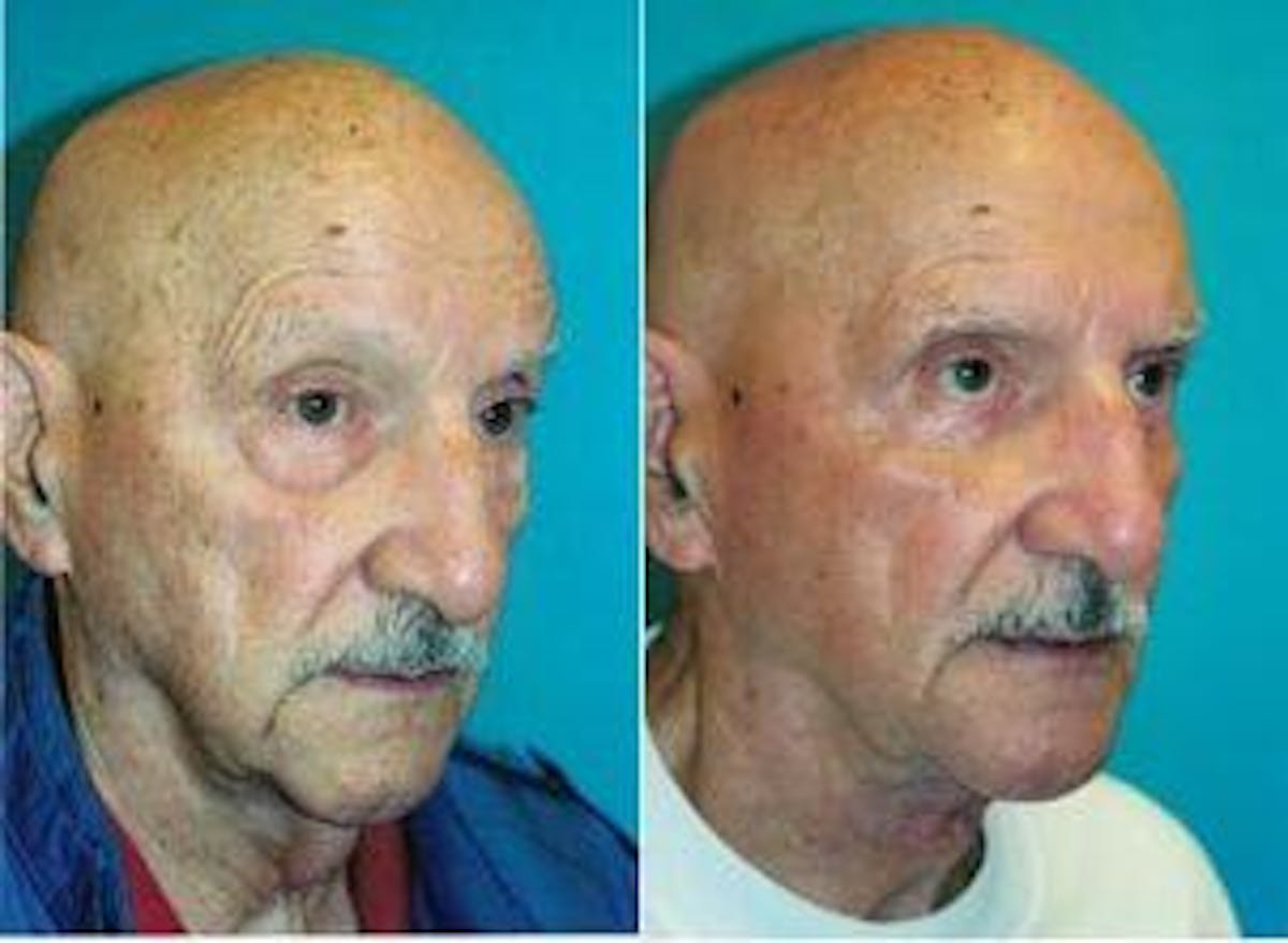 Male Neck Lift Before & After Gallery - Patient 122406298 - Image 3