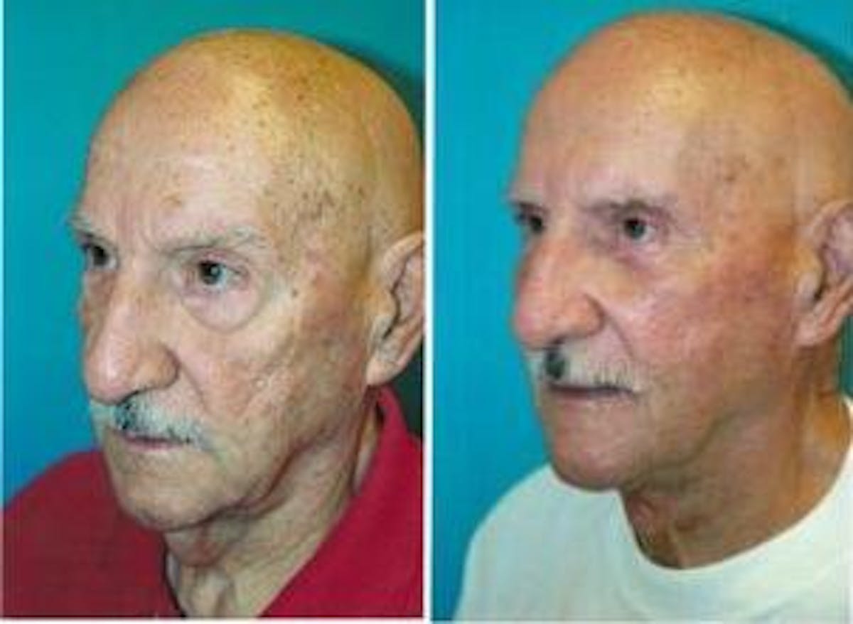 Male Neck Lift Before & After Gallery - Patient 122406298 - Image 4