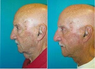 Male Neck Lift Before & After Gallery - Patient 122406298 - Image 5