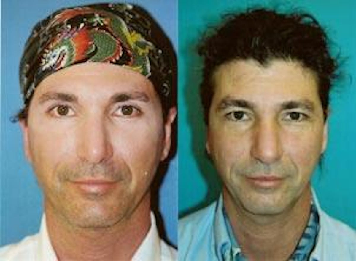 Male Neck Lift Before & After Gallery - Patient 122406299 - Image 1