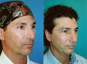 Male Neck Lift Before & After Gallery - Patient 122406299 - Image 2