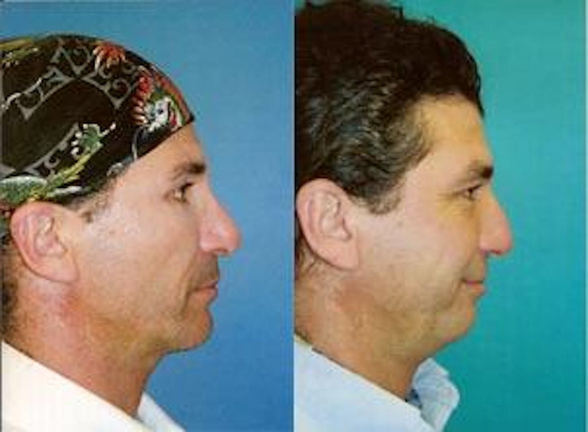 Male Neck Lift Before & After Gallery - Patient 122406299 - Image 3